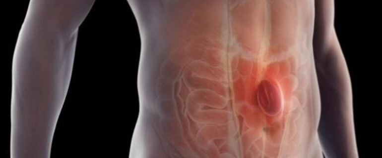 cirugia hernia cancun